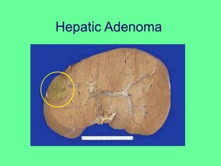 Hepatic Adenoma
 