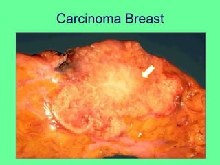 Carcinoma Breast
 