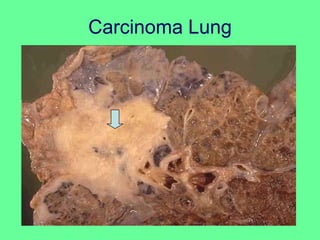 Carcinoma Lung
 