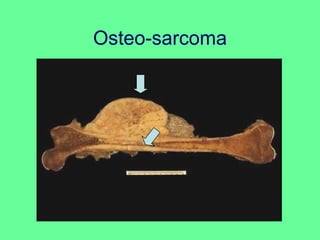 Osteo-sarcoma
 