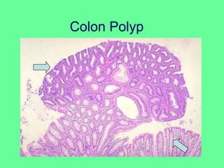 Colon Polyp
 