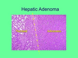 Hepatic Adenoma
Normal Adenoma
 