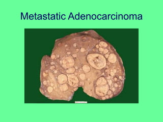 Metastatic Adenocarcinoma
 
