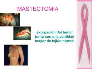 MASTECTOMIA extirpación del tumor junto con una cantidad mayor de tejido normal  