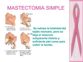 MASTECTOMIA SIMPLE Se extirpa la totalidad del tejido mamario, pero se deja el músculo subyacente intacto y suficiente piel como para cubrir la herida.  
