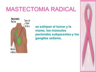 MASTECTOMIA RADICAL  se extirpan el tumor y la mama, los músculos pectorales subyacentes y los ganglios axilares. 
