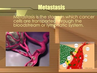 Metastasis 
Metastasis is the stage in which cancer 
cells are transported through the 
bloodstream or lymphatic system. 
 