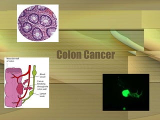 Colon Cancer 
 