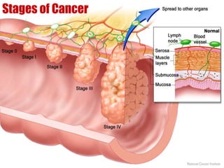 Stages of Cancer 
 