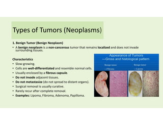 Types of Tumors (Neoplasms)
1. Benign Tumor (Benign Neoplasm)
• A benign neoplasm is a non-cancerous tumor that remains localized and does not invade
surrounding tissues.
Characteristics
• Slow-growing.
• Cells are well-differentiated and resemble normal cells.
• Usually enclosed by a fibrous capsule.
• Do not invade adjacent tissues.
• Do not metastasize (do not spread to distant organs).
• Surgical removal is usually curative.
• Rarely recur after complete removal.
• Examples: Lipoma, Fibroma, Adenoma, Papilloma.
 