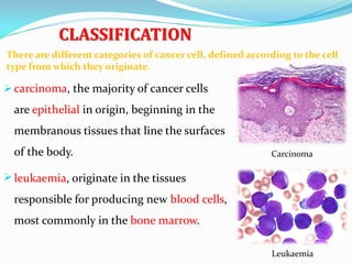 CLASSIFICATION
 carcinoma, the majority of cancer cells
are epithelial in origin, beginning in the
membranous tissues that line the surfaces
of the body.
 leukaemia, originate in the tissues
responsible for producing new blood cells,
most commonly in the bone marrow.
Carcinoma
There are different categories of cancer cell, defined according to the cell
type from which they originate.
Leukaemia
 