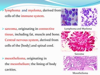  lymphoma and myeloma, derived from
cells of the immune system.
 sarcoma, originating in connective
tissue, including fat, muscle and bone.
Central nervous system, derived from
cells of the [body] and spinal cord.
 mesothelioma, originating in
the mesothelium; the lining of body
cavities.
Lymphoma and Myeloma
Sarcoma
Mesothelioma
 