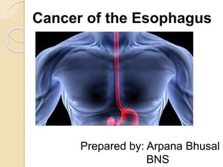 Cancer of the Esophagus
Prepared by: Arpana Bhusal
BNS
 