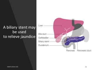 A biliary stent may
be used
to relieve jaundice
15
 
