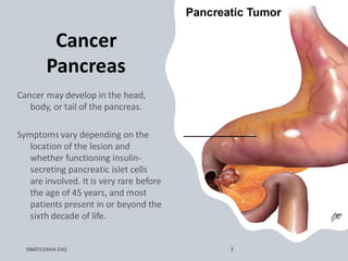 Cancer
Pancreas
 