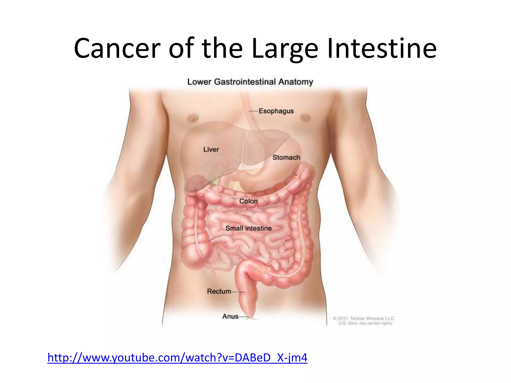 Cancer of the large intestine [autosaved] | PPT
