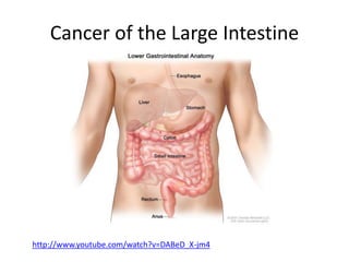 Cancer of the Large Intestine
http://www.youtube.com/watch?v=DABeD_X-jm4
 