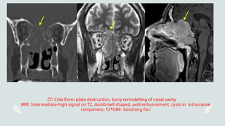 Cancer of the Nasal Cavity and paranasal sinus .pptx