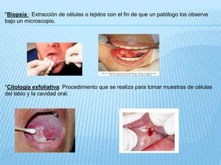 *Biopsia : Extracción de células o tejidos con el fin de que un patólogo los observe
bajo un microscopio.
*Citología exfoliativa: Procedimiento que se realiza para tomar muestras de células
del labio y la cavidad oral.
 
