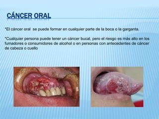 CÁNCER ORAL
*El cáncer oral se puede formar en cualquier parte de la boca o la garganta.
*Cualquier persona puede tener un cáncer bucal, pero el riesgo es más alto en los
fumadores o consumidores de alcohol o en personas con antecedentes de cáncer
de cabeza o cuello
 