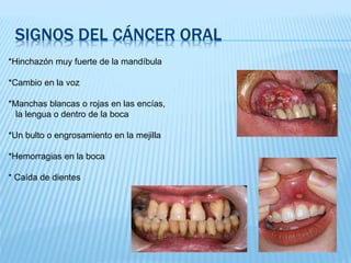 SIGNOS DEL CÁNCER ORAL
*Hinchazón muy fuerte de la mandíbula
*Cambio en la voz
*Manchas blancas o rojas en las encías,
la lengua o dentro de la boca
*Un bulto o engrosamiento en la mejilla
*Hemorragias en la boca
* Caída de dientes
 