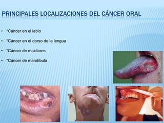PRINCIPALES LOCALIZACIONES DEL CÁNCER ORAL
• *Cáncer en el labio
• *Cáncer en el dorso de la lengua
• *Cáncer de maxilares
• *Cáncer de mandíbula
 