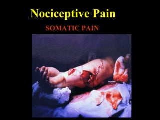 Nociceptive Pain
SOMATIC PAIN
 