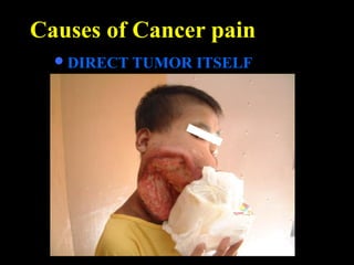 Causes of Cancer pain
DIRECT TUMOR ITSELF
 