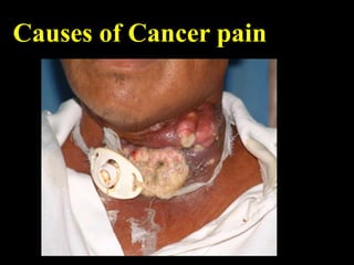 Causes of Cancer pain
 
