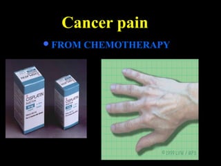 Cancer pain
FROM CHEMOTHERAPY
 