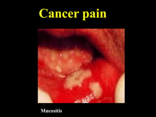 Cancer pain
Mucositis
 
