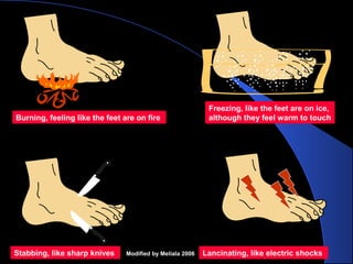Burning, feeling like the feet are on fire
Stabbing, like sharp knives Lancinating, like electric shocks
Freezing, like the feet are on ice,
although they feel warm to touch
Modified by Meliala 2006
 