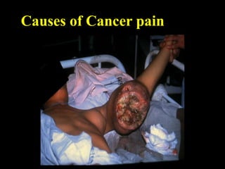 Causes of Cancer pain
 
