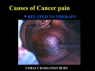 Causes of Cancer pain
RELATED TO THERAPY
COBALT RADIATION BURN
 