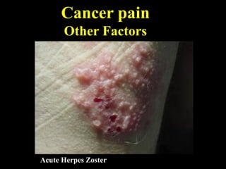 Cancer pain
Other Factors
Acute Herpes Zoster
 