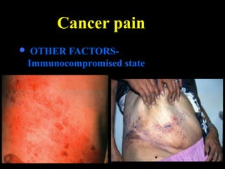 Cancer pain
 OTHER FACTORS-
Immunocompromised state
 