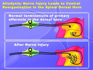 Allodynia: Nerve Injury Leads to Central
Reorganization in the Spinal Dorsal Horn
Normal terminations of primary
afferents in the dorsal horn
After Nerve Injury
 