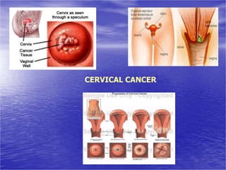 CERVICAL CANCER
 