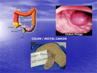 COLON / RECTAL CANCER
 