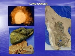 LUNG CANCER
 