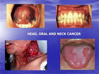 HEAD, ORAL AND NECK CANCER
 