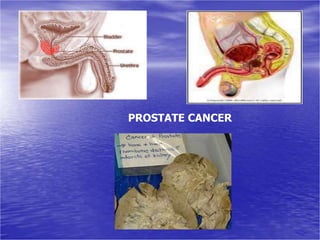 PROSTATE CANCER
 