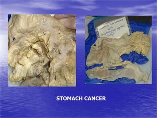 STOMACH CANCER
 