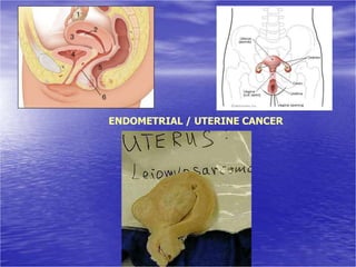 ENDOMETRIAL / UTERINE CANCER
 