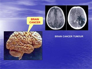 BRAIN
CANCER
BRAIN CANCER TUMOUR
 