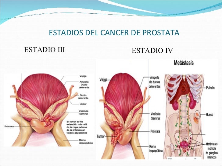 Cancer Prostata Cancer Prostata
