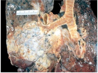 CANCER PULMON 2.pptx