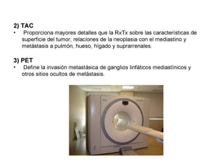 CANCER PULMON 2.pptx