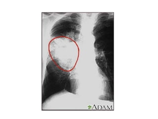 CANCER PULMON 2.pptx