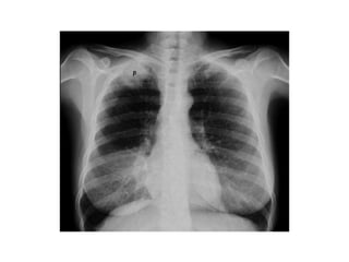 CANCER PULMON 2.pptx